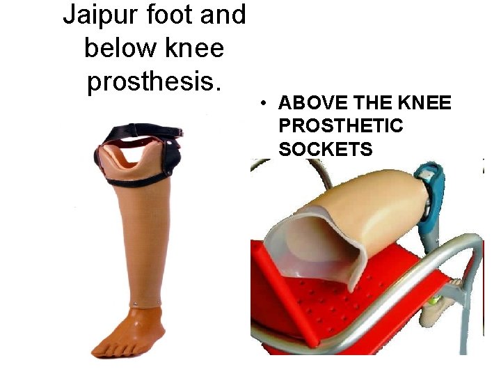 Jaipur foot and below knee prosthesis. • ABOVE THE KNEE PROSTHETIC SOCKETS 