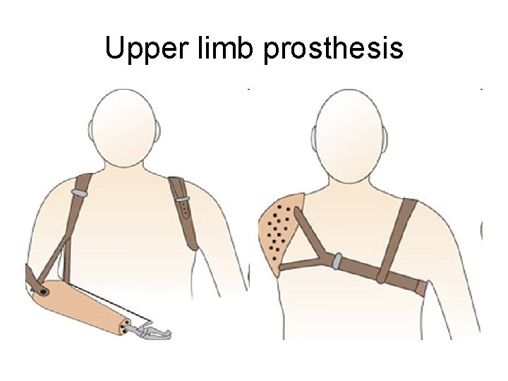 Upper limb prosthesis 