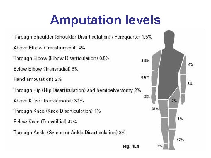 Amputation levels 