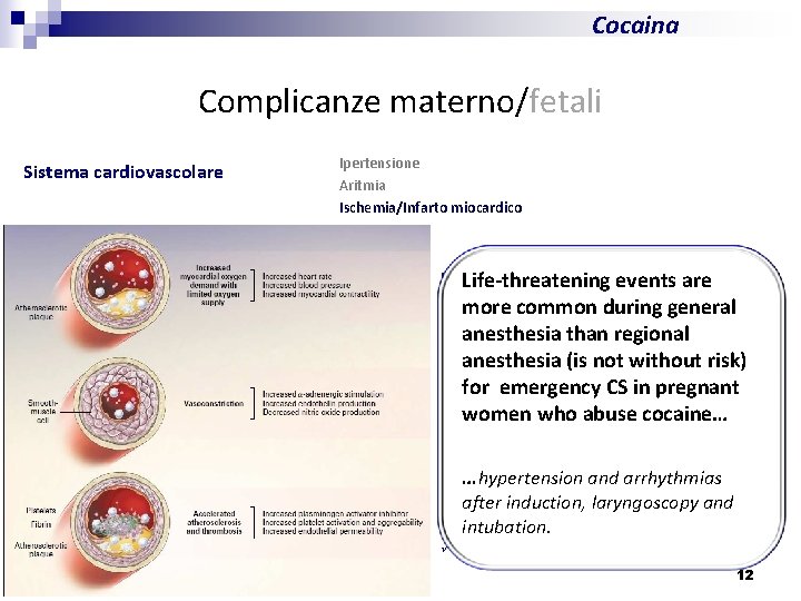 Cocaina Complicanze materno/fetali Sistema cardiovascolare Ipertensione Aritmia Ischemia/Infarto miocardico Raccomandazione AHA/Management Farmaci di I°