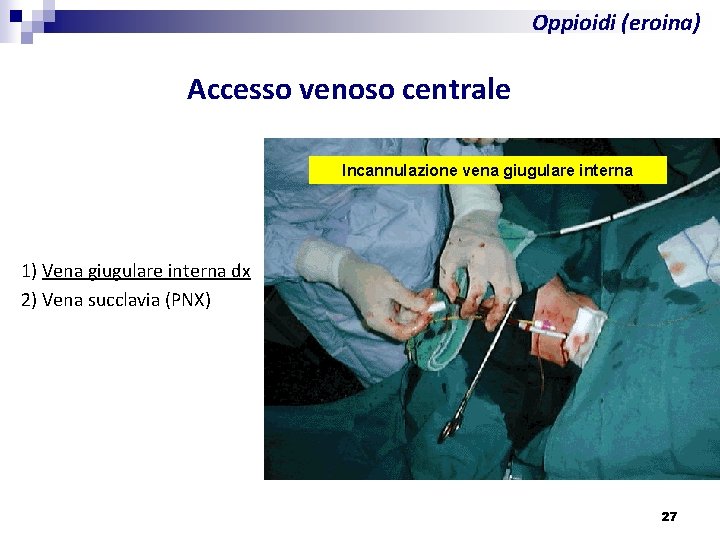 Oppioidi (eroina) Accesso venoso centrale Incannulazione vena giugulare interna 1) Vena giugulare interna dx