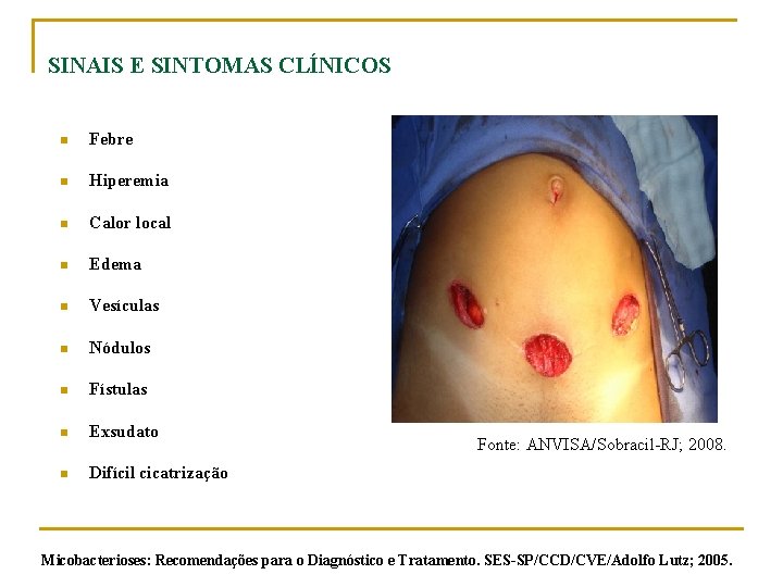 SINAIS E SINTOMAS CLÍNICOS n Febre n Hiperemia n Calor local n Edema n