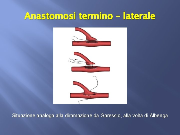 Anastomosi termino – laterale Situazione analoga alla diramazione da Garessio, alla volta di Albenga