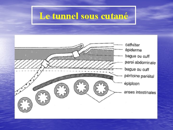 Le tunnel sous cutané 