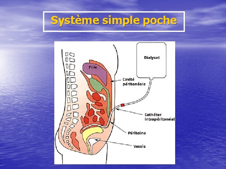 Système simple poche 
