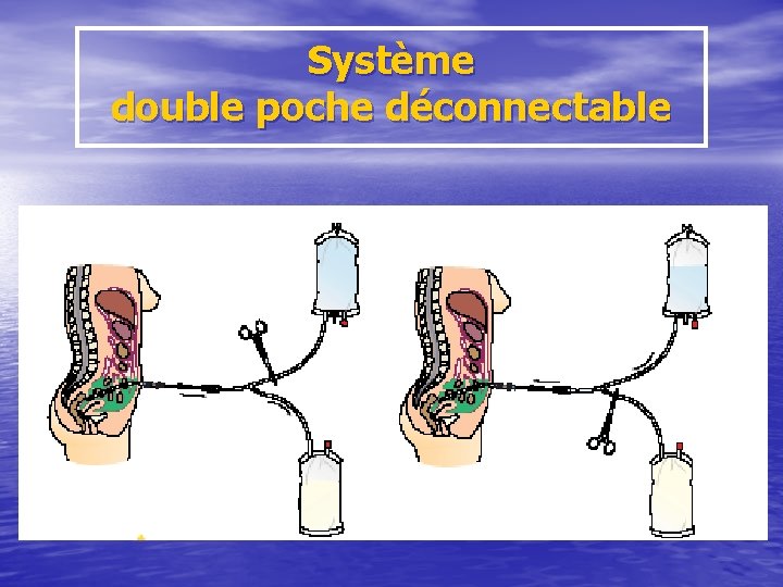 Système double poche déconnectable 