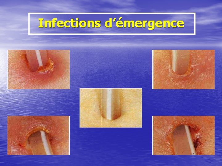 Infections d’émergence 