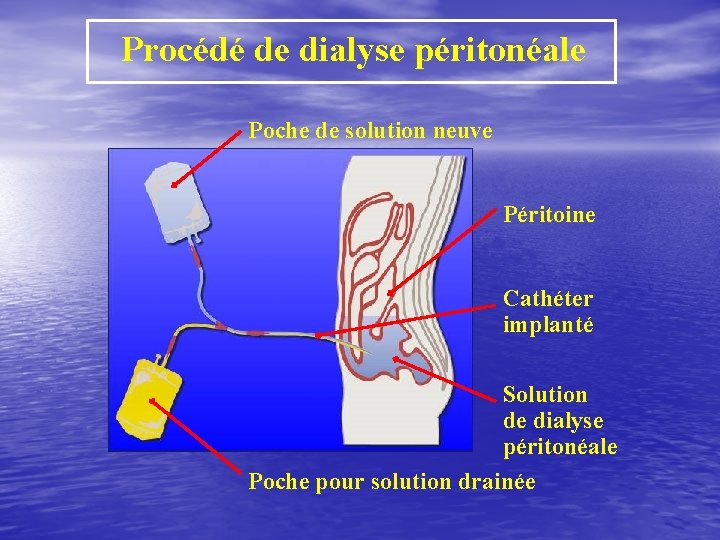 Procédé de dialyse péritonéale Poche de solution neuve Péritoine Cathéter implanté Solution de dialyse