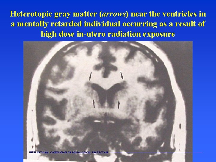 Heterotopic gray matter (arrows) near the ventricles in a mentally retarded individual occurring as