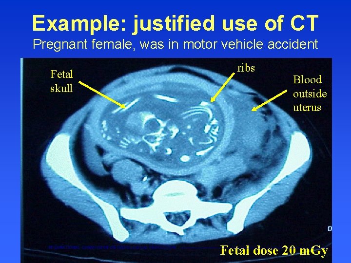 Example: justified use of CT Pregnant female, was in motor vehicle accident Fetal skull