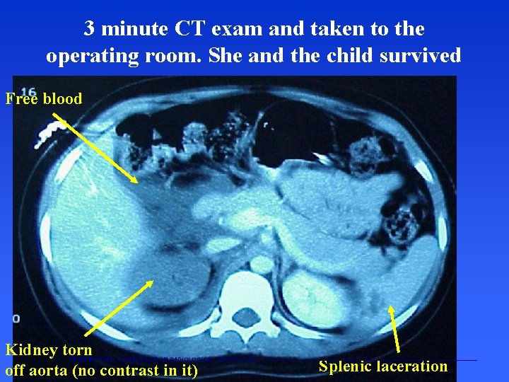 3 minute CT exam and taken to the operating room. She and the child