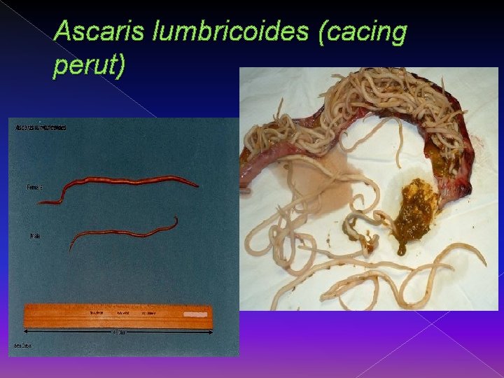 Ascaris lumbricoides (cacing perut) 