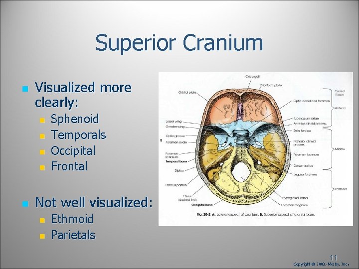 Superior Cranium n Visualized more clearly: n n n Sphenoid Temporals Occipital Frontal Not Superior Cranium n Visualized more clearly: n n n Sphenoid Temporals Occipital Frontal Not