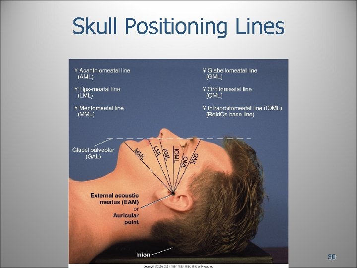Skull Positioning Lines 30 Skull Positioning Lines 30
