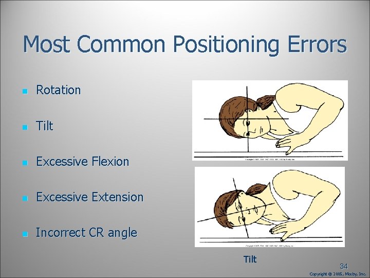 Most Common Positioning Errors n Rotation n Tilt n Excessive Flexion n Excessive Extension Most Common Positioning Errors n Rotation n Tilt n Excessive Flexion n Excessive Extension