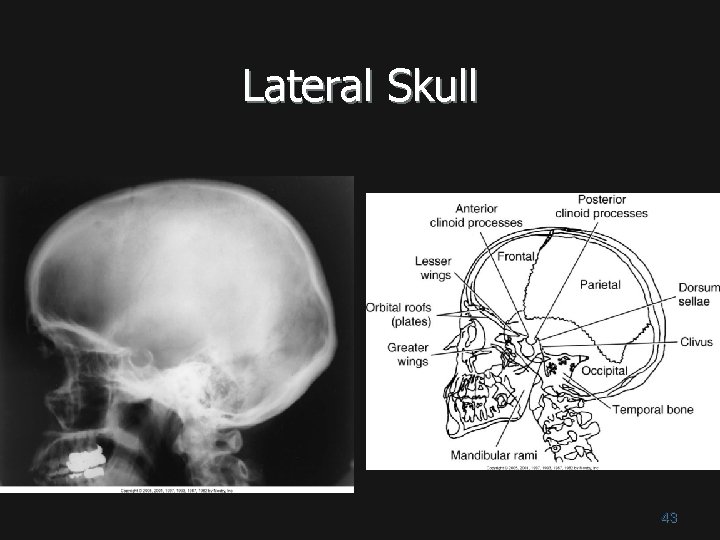 Lateral Skull 43 Lateral Skull 43