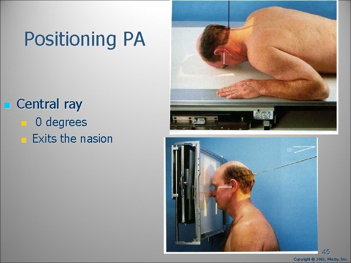 Positioning PA n Central ray n n 0 degrees Exits the nasion 45 Copyright Positioning PA n Central ray n n 0 degrees Exits the nasion 45 Copyright