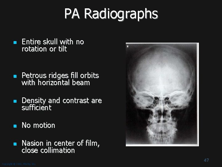 PA Radiographs n Entire skull with no rotation or tilt n Petrous ridges fill PA Radiographs n Entire skull with no rotation or tilt n Petrous ridges fill