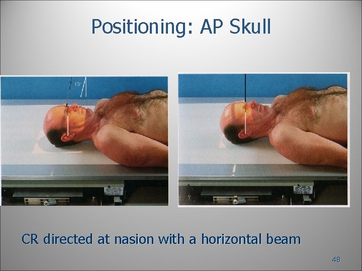 Positioning: AP Skull CR directed at nasion with a horizontal beam 48 Positioning: AP Skull CR directed at nasion with a horizontal beam 48