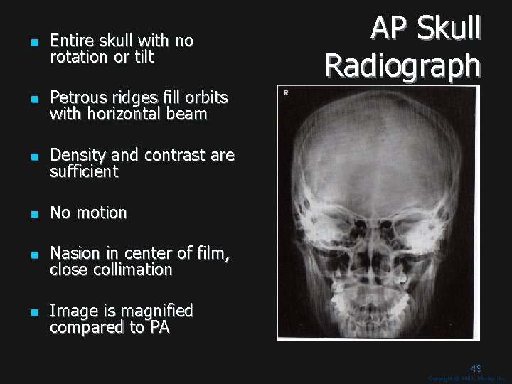 n Entire skull with no rotation or tilt n Petrous ridges fill orbits with n Entire skull with no rotation or tilt n Petrous ridges fill orbits with