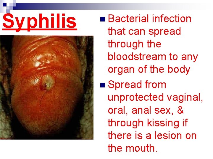 Syphilis n Bacterial infection that can spread through the bloodstream to any organ of