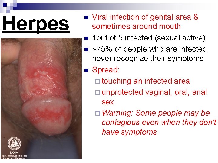 Herpes n n Viral infection of genital area & sometimes around mouth 1 out