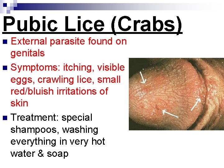 Pubic Lice (Crabs) External parasite found on genitals n Symptoms: itching, visible eggs, crawling