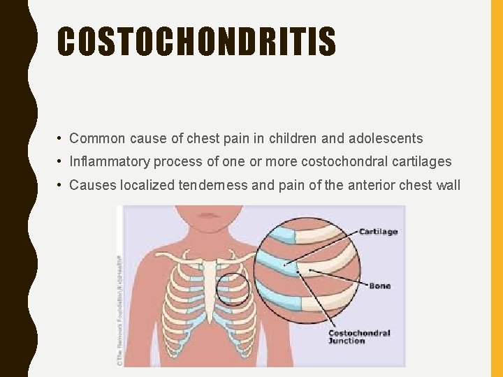 COSTOCHONDRITIS • Common cause of chest pain in children and adolescents • Inflammatory process