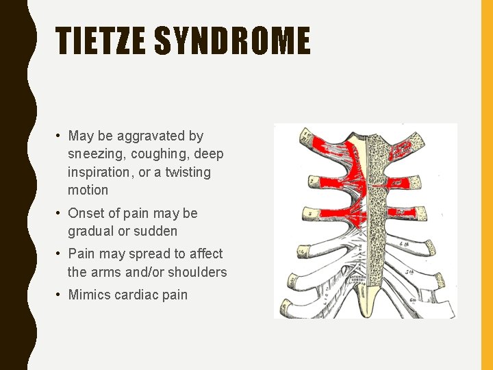 TIETZE SYNDROME • May be aggravated by sneezing, coughing, deep inspiration, or a twisting