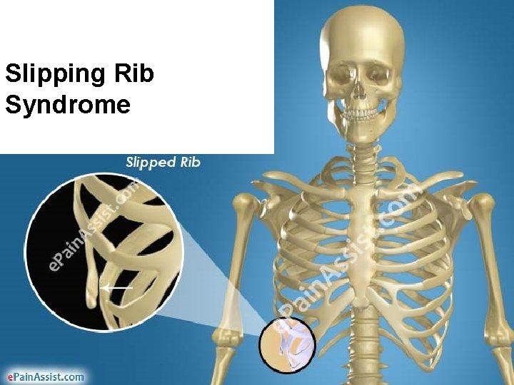 Slipping Rib Syndrome 