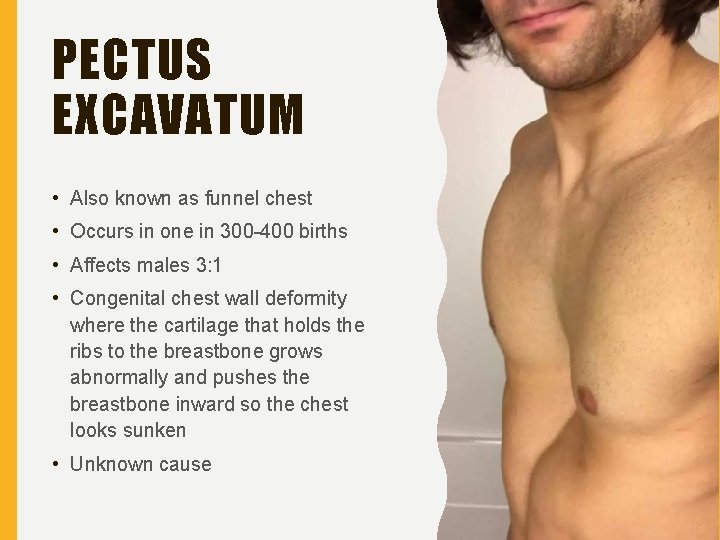 PECTUS EXCAVATUM • Also known as funnel chest • Occurs in one in 300