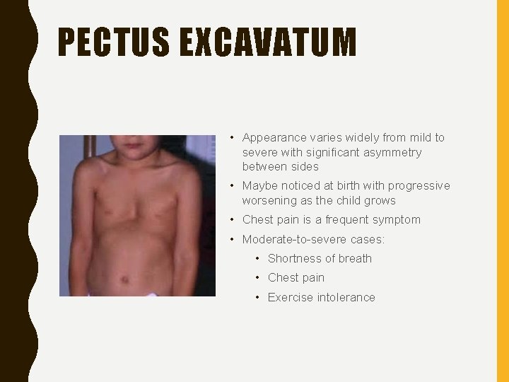 PECTUS EXCAVATUM • Appearance varies widely from mild to severe with significant asymmetry between