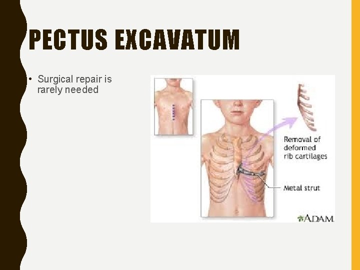 PECTUS EXCAVATUM • Surgical repair is rarely needed 