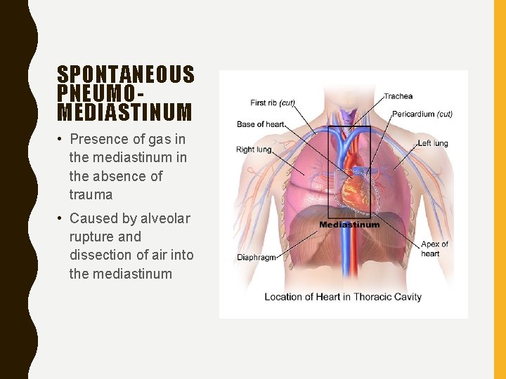 SPONTANEOUS PNEUMOMEDIASTINUM • Presence of gas in the mediastinum in the absence of trauma
