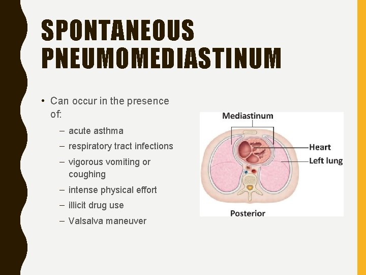 SPONTANEOUS PNEUMOMEDIASTINUM • Can occur in the presence of: – acute asthma – respiratory