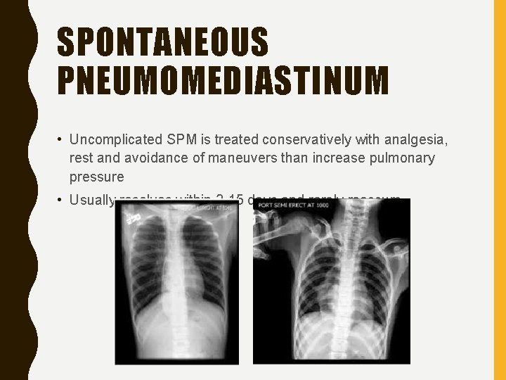 SPONTANEOUS PNEUMOMEDIASTINUM • Uncomplicated SPM is treated conservatively with analgesia, rest and avoidance of