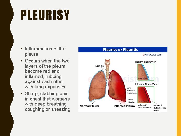 PLEURISY • Inflammation of the pleura • Occurs when the two layers of the