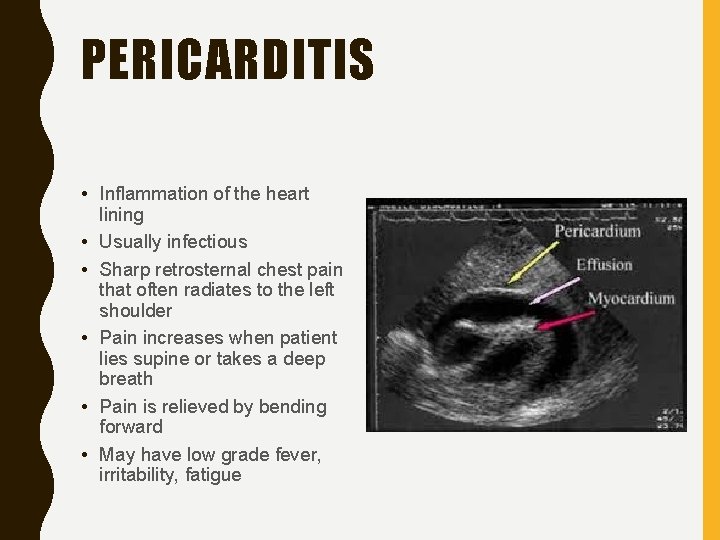 PERICARDITIS • Inflammation of the heart lining • Usually infectious • Sharp retrosternal chest