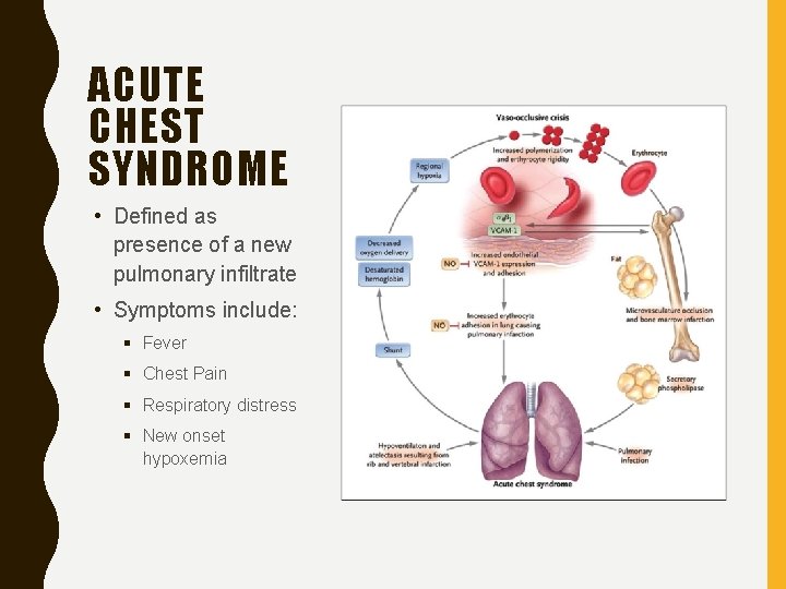 ACUTE CHEST SYNDROME • Defined as presence of a new pulmonary infiltrate • Symptoms