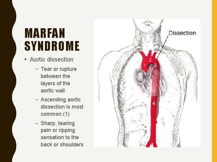 MARFAN SYNDROME • Aortic dissection – Tear or rupture between the layers of the