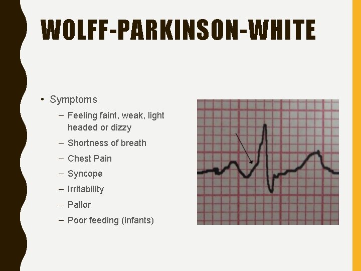 WOLFF-PARKINSON-WHITE • Symptoms – Feeling faint, weak, light headed or dizzy – Shortness of