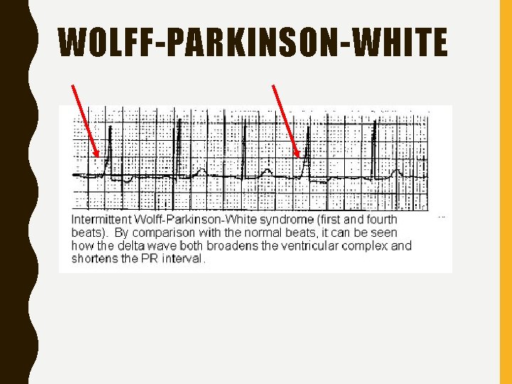 WOLFF-PARKINSON-WHITE 