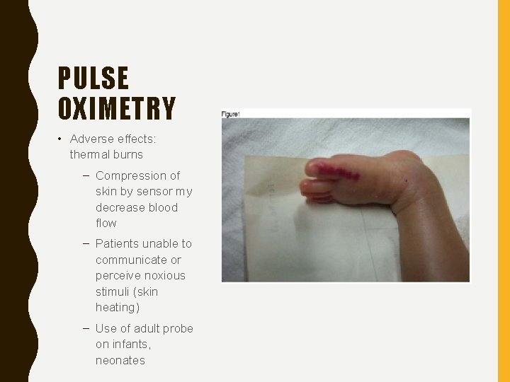 PULSE OXIMETRY • Adverse effects: thermal burns – Compression of skin by sensor my