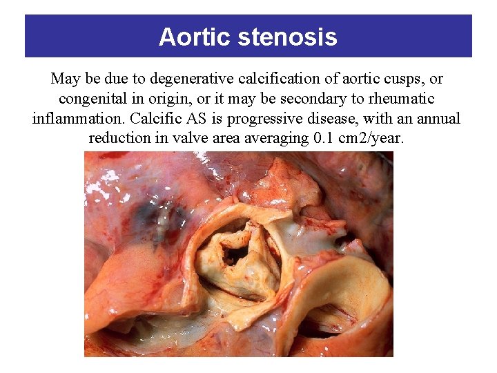 Aortic stenosis May be due to degenerative calcification of aortic cusps, or congenital in