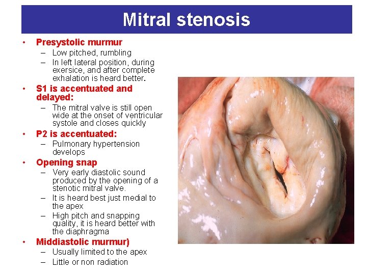 Mitral stenosis • Presystolic murmur – Low pitched, rumbling – In left lateral position,