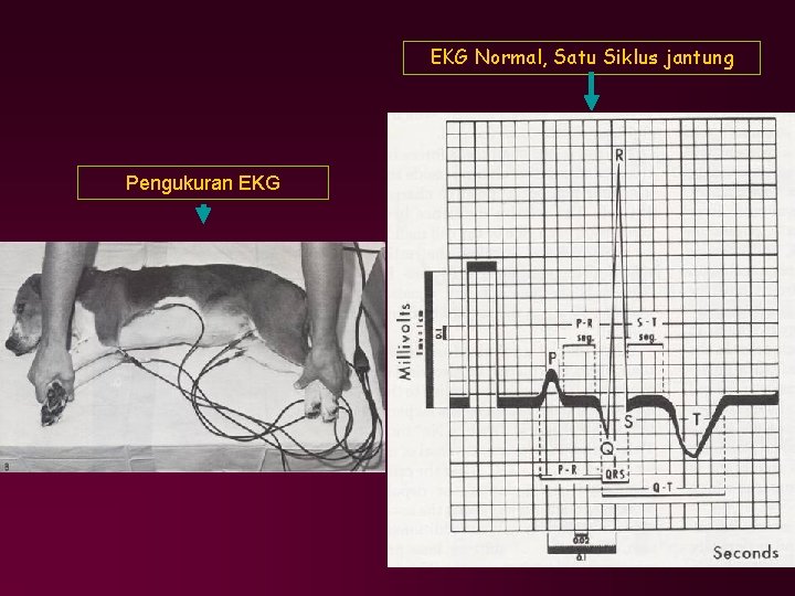 EKG Normal, Satu Siklus jantung Pengukuran EKG 