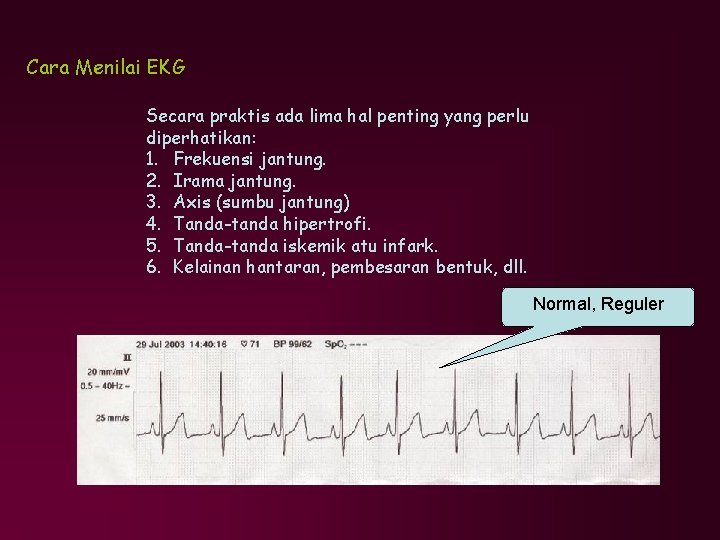 Cara Menilai EKG Secara praktis ada lima hal penting yang perlu diperhatikan: 1. Frekuensi