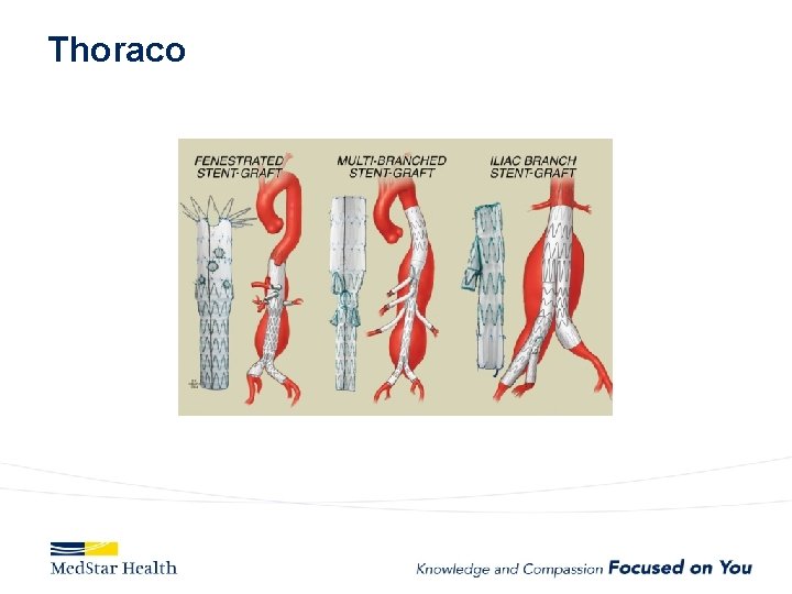 Thoraco 