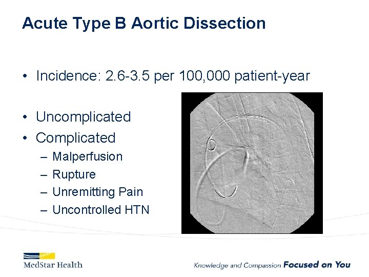 Acute Type B Aortic Dissection • Incidence: 2. 6 -3. 5 per 100, 000