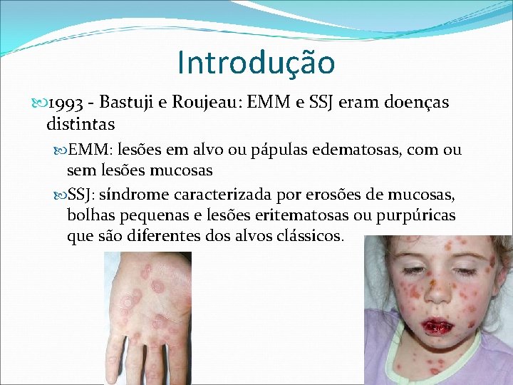 Introdução 1993 - Bastuji e Roujeau: EMM e SSJ eram doenças distintas EMM: lesões